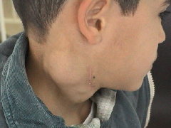 Hodgkins Disease Pictures