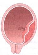 low lying placenta