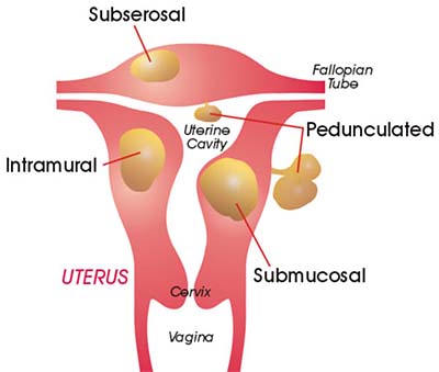 Uterine Fibroid Symptoms and Kinds
