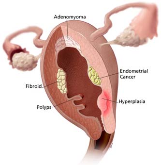 more about adenomyosis and its symptoms