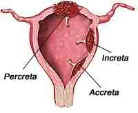 placenta accreta