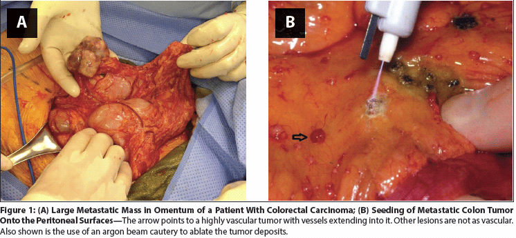 Peritoneal_Carcinomatosis_and_Gastrointestinal_Cancer