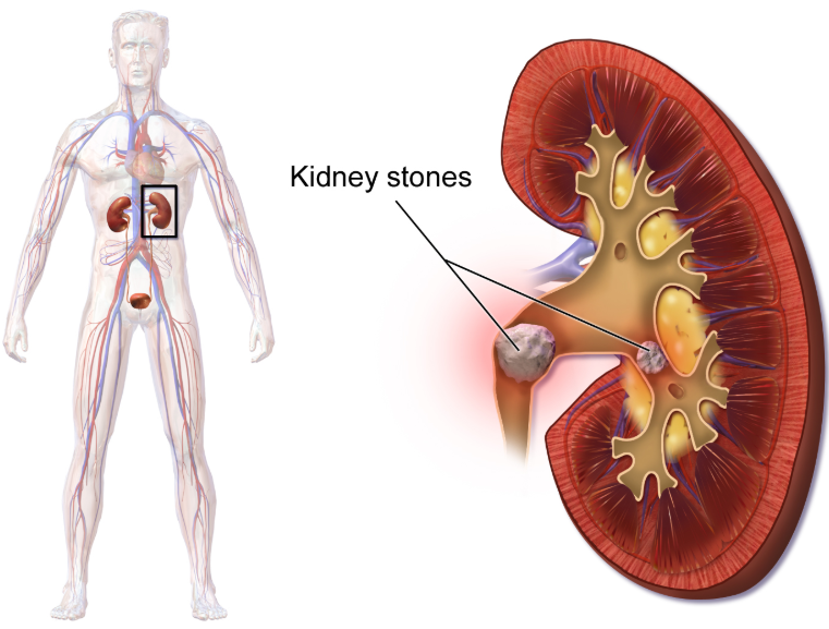 11 Kidney Stone Home Remedy Advice