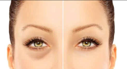 Eye_bags