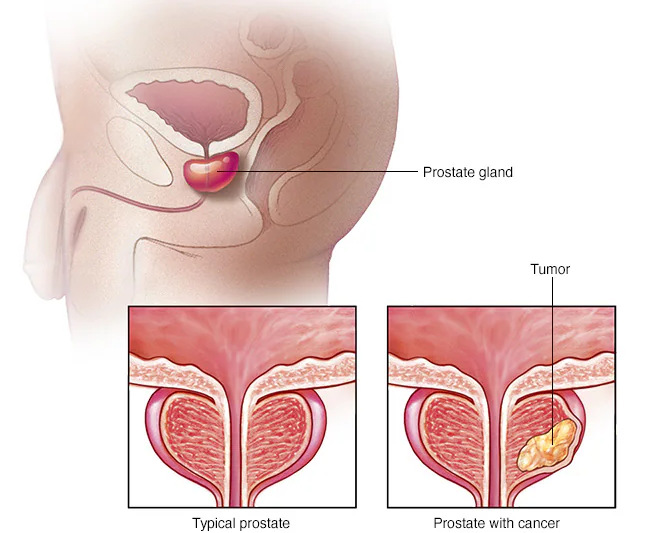Sexual Intercourse and Other Risk Factors of Prostate Cancer